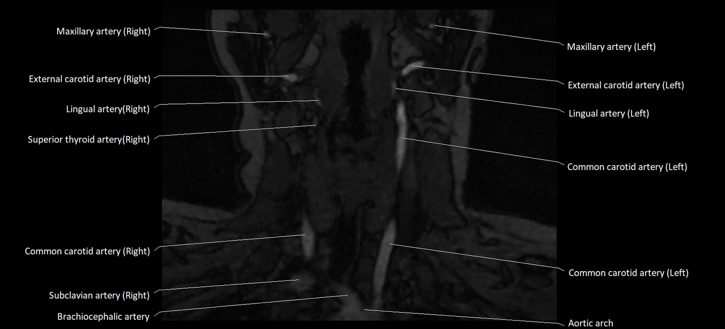 MRA carotid artery anatomy cross sectional 3T coronal image 4.webp